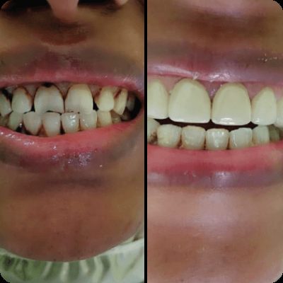 Front-teeth makeover