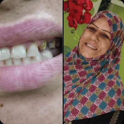 Full smile restoration